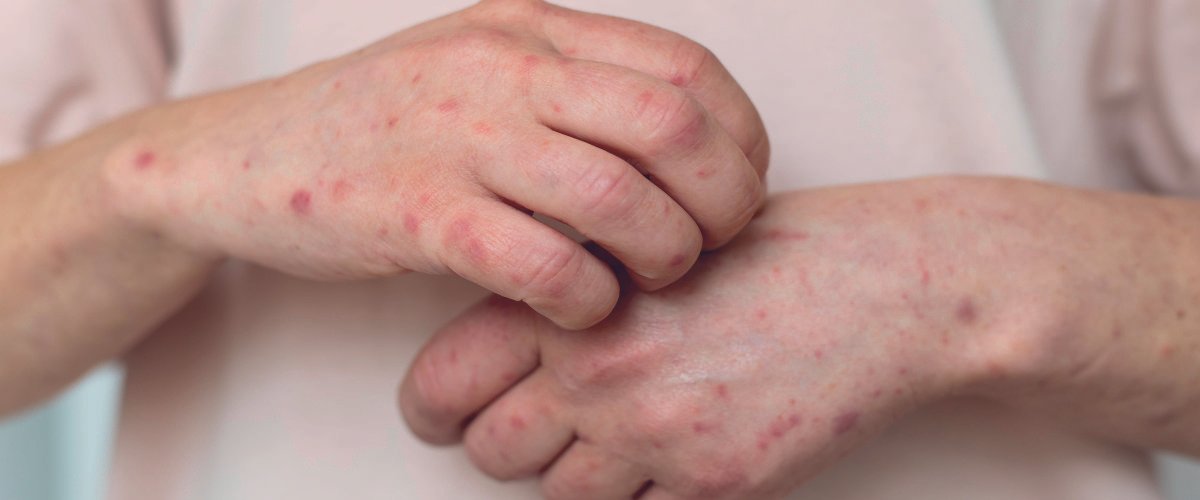 symptoms of bed bug bites