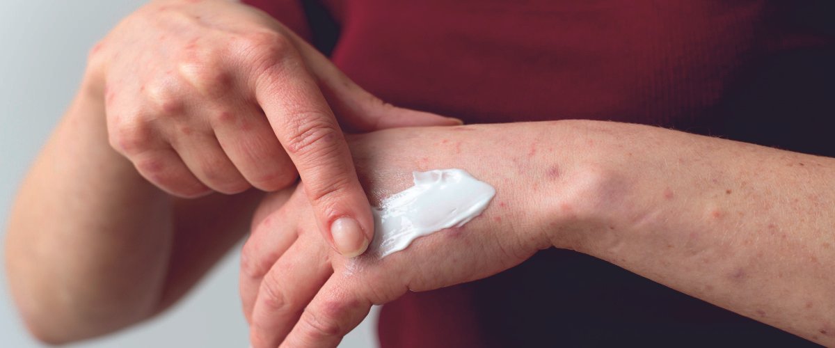 Bed bug Bite treatment